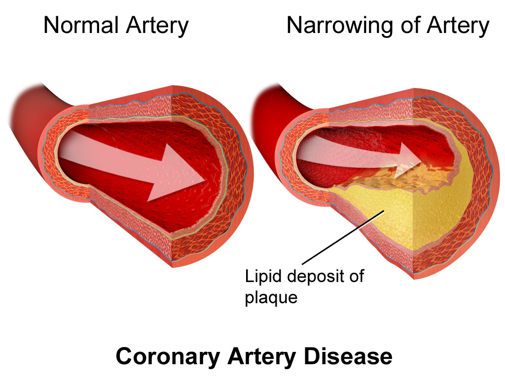 occlusions of coronary artery's! - ib blogging